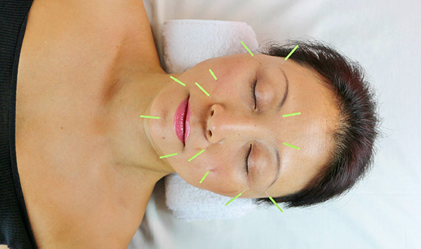 Acupuntura Estética Tenerife. Aesthetic Acupuncture Tenerife